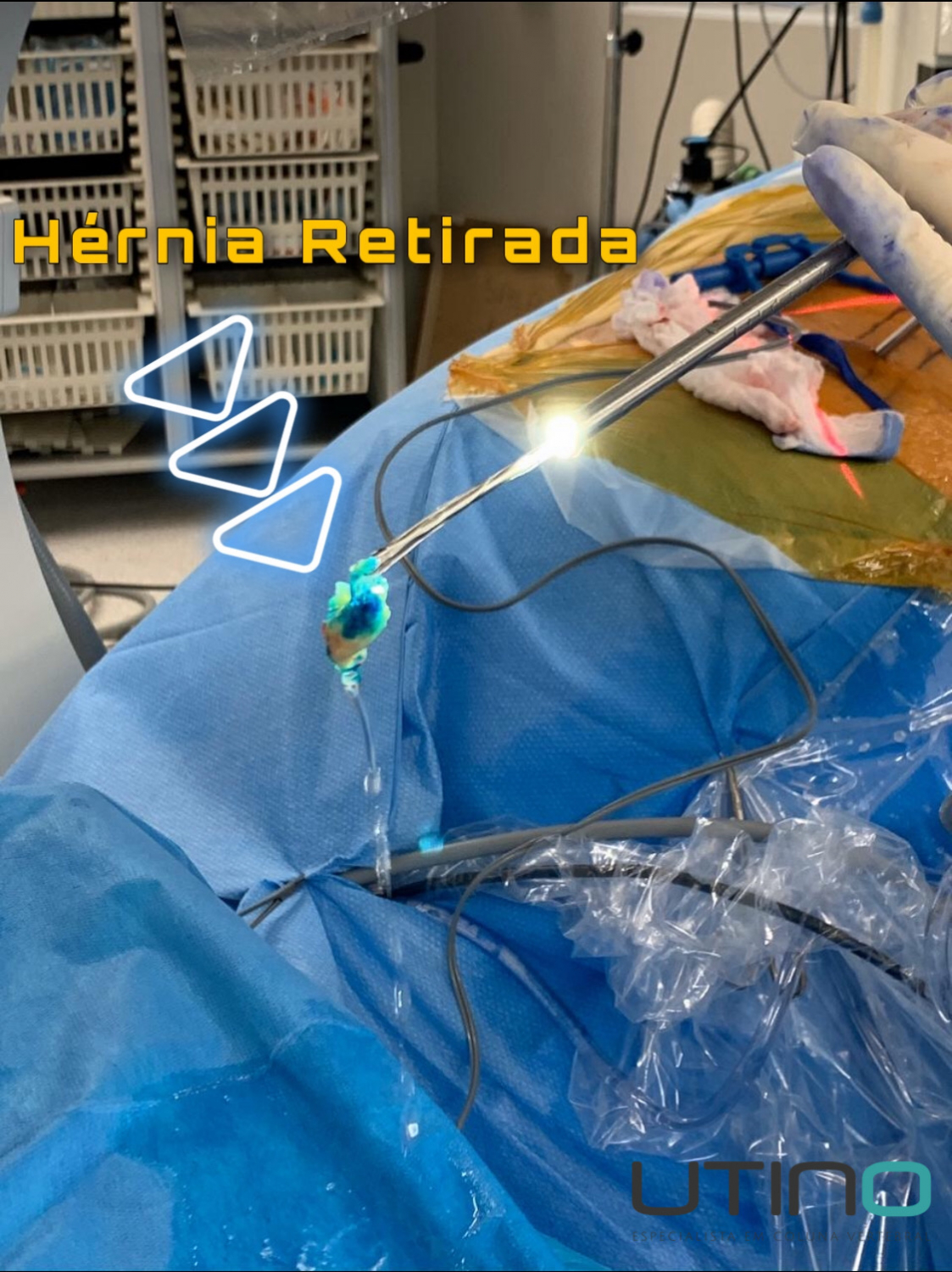 Cirurgia Minimamente Invasiva de Hérnia de Disco - Dr. Edgar Utino