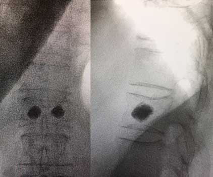 resultado da cifoplastia 