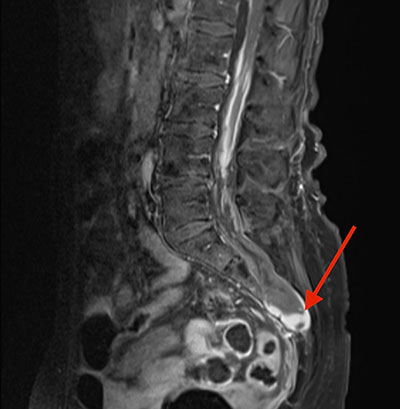 ressonância magnética da coluna lombossacra