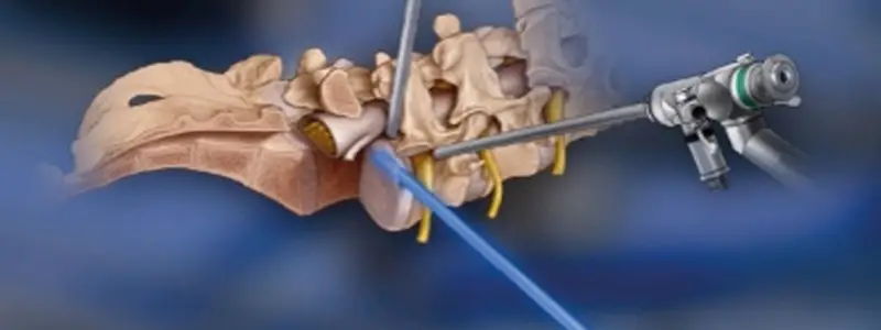 Endoscopia da coluna: cirurgia minimamente invasiva